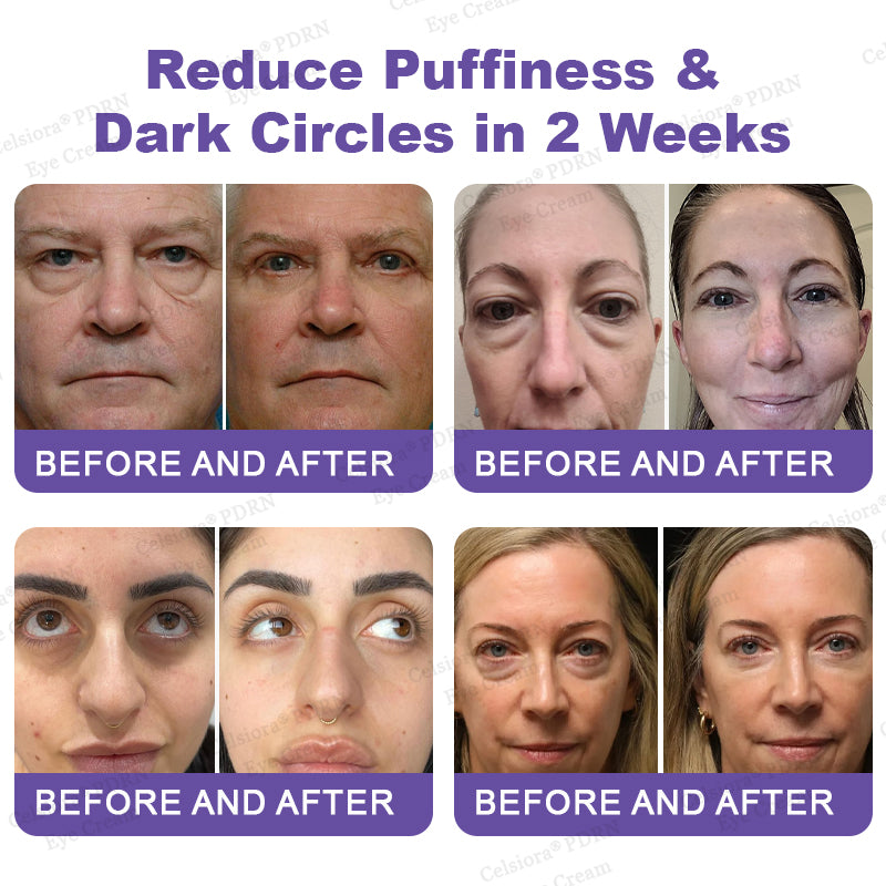 💄✨Celsiora® PDRN Renewal Complex Eye Cream | Wrinkles, Puffiness & Dark Circles
