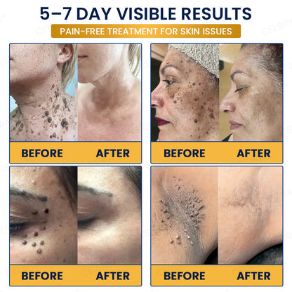 🧶GFOUK® 7-Day MicroNeedle Wart & Skin Tag Removal Patch