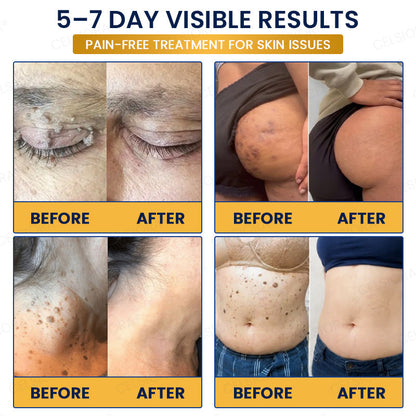 🧶GFOUK® 7-Day MicroNeedle Wart & Skin Tag Removal Patch
