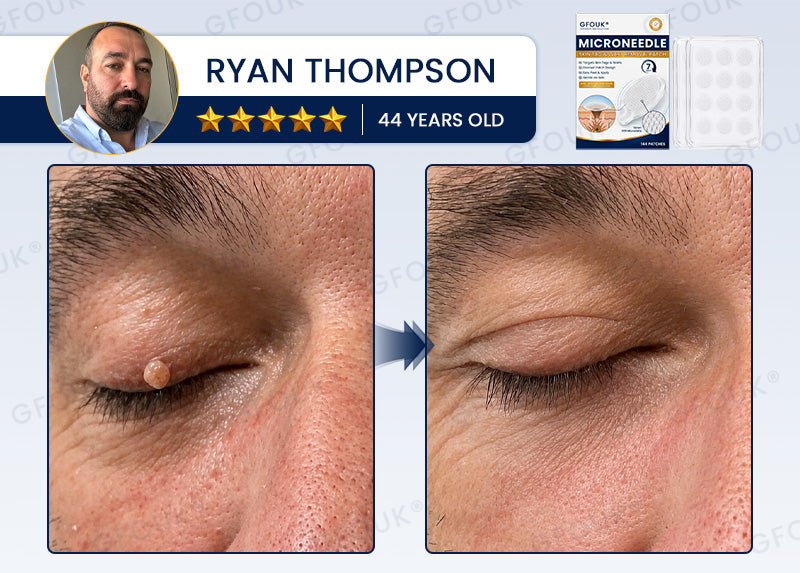 🧶GFOUK® 7-Day MicroNeedle Wart & Skin Tag Removal Patch