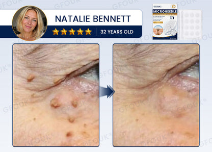 🧶GFOUK® 7-Day MicroNeedle Wart & Skin Tag Removal Patch